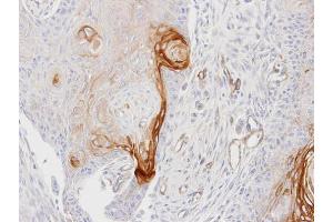 IHC-P Image Immunohistochemical analysis of paraffin-embedded Ca922 xenograft, using ENTPD6, antibody at 1:100 dilution. (ENTPD6 antibody  (Center))