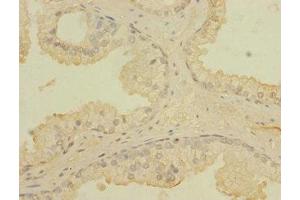 Immunohistochemistry of paraffin-embedded human prostata cancer using ABIN7171721 at dilution of 1:100 (CCDC79 antibody  (AA 301-550))