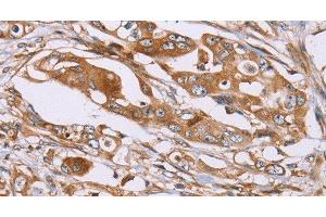 Immunohistochemistry of paraffin-embedded Human colon cancer using OS9 Polyclonal Antibody at dilution of 1:30 (OS9 antibody)
