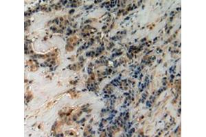 IHC-P analysis of Human Breast Cancer Tissue, with DAB staining. (CHI3L1 antibody  (AA 112-377))