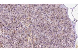 ABIN6273297 at 1/100 staining Human pancreas cancer tissue by IHC-P. (PIK3IP1 antibody  (N-Term))