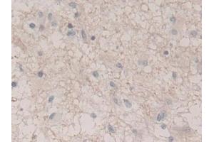 Detection of UCRP in Human Glioma Tissue using Polyclonal Antibody to Ubiquitin Cross Reactive Protein (UCRP) (CLRN1 Antisense RNA 1 (CLRN1-AS1) (AA 2-157) antibody)