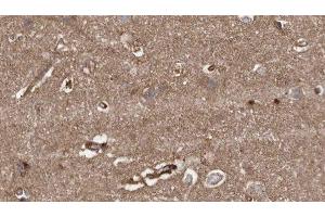 ABIN6279389 at 1/100 staining Human brain cancer tissue by IHC-P. (HACE1 antibody  (C-Term))