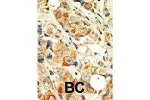 Formalin-fixed and paraffin-embedded human cancer tissue reacted with PRKCA polyclonal antibody  , which was peroxidase-conjugated to the secondary antibody, followed by DAB staining . (PKC alpha antibody  (C-Term))