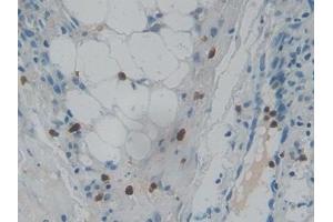 Detection of RNASE3 in Human Skin cancer Tissue using Polyclonal Antibody to Ribonuclease A3 (RNASE3) (RNASE3 antibody  (AA 30-154))