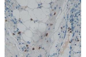 Detection of RNASE3 in Human Skin cancer Tissue using Polyclonal Antibody to Ribonuclease A3 (RNASE3) (RNASE3 antibody  (AA 30-154))