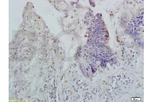 Formalin-fixed and paraffin embedded human rectal carcinoma labeled with Rabbit Anti APOA2 Polyclonal Antibody, Unconjugated (ABIN708686) at 1:200 followed by conjugation to the secondary antibody and DAB staining