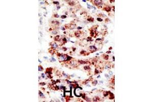 Formalin-fixed and paraffin-embedded human hepatocellular carcinoma tissue reacted with the UBB polyclonal antibody  , which was peroxidase-conjugated to the secondary antibody, followed by AEC staining. (Ubiquitin B antibody  (C-Term))