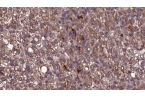 ABIN6276824 at 1/100 staining Human liver cancer tissue by IHC-P.