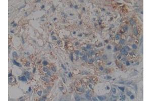DAB staining on IHC-P; Samples: Human Pancreatic cancer Tissue (NME4 antibody  (AA 67-185))