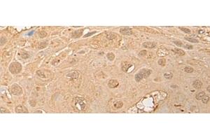Immunohistochemistry of paraffin-embedded Human esophagus cancer tissue using CPNE3 Polyclonal Antibody at dilution of 1:40(x200) (Copine III antibody)