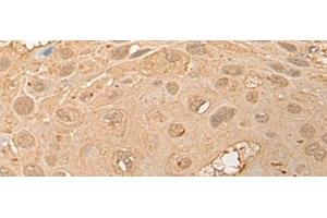 Immunohistochemistry of paraffin-embedded Human esophagus cancer tissue using CPNE3 Polyclonal Antibody at dilution of 1:40(x200)