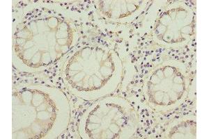 Immunohistochemistry of paraffin-embedded human colon cancer using ABIN7152640 at dilution of 1:100 (FABP1 antibody  (AA 1-127))