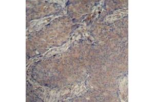 Immunohistochemistry of paraffin-embedded human breast carcinoma using Phospho-MYL12A-S18 antibody (ABIN2988196). (MYL12A antibody  (pSer18))