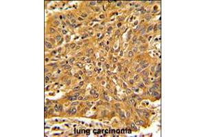 Formalin-fixed and paraffin-embedded human lung carcinoma with Fascin Antibody , which was peroxidase-conjugated to the secondary antibody, followed by DAB staining. (Fascin antibody  (AA 322-350))
