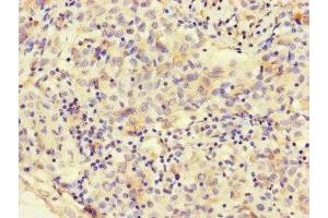 Immunohistochemistry of paraffin-embedded human lung cancer using ABIN7160331 at dilution of 1:100 (FAT Atypical Cadherin 2 (FAT2) (AA 123-314) antibody)