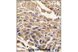 Formalin-fixed and paraffin-embedded human lung carcinoma tissue reacted with ARSB antibody (C-term) (ABIN391670 and ABIN2841581) , which was peroxidase-conjugated to the secondary antibody, followed by DAB staining.