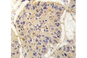 IHC analysis of FFPE human lung carcinoma tissue stained with FKBP12 antibody (FKBP1A antibody  (AA 43-74))
