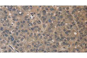 Immunohistochemistry of paraffin-embedded Human liver cancer using DRG1 Polyclonal Antibody at dilution of 1:30 (DRG1 antibody)