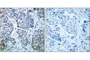 Immunohistochemistry analysis of paraffin-embedded human breast carcinoma, using SEK1/MKK4 (Phospho-Thr261) Antibody. (MAP2K4 antibody  (pThr261))