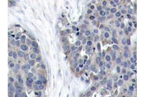 Immunohistochemistry analyzes of Op18 antibody in paraffin-embedded human breast carcinoma tissue. (Stathmin 1 antibody)