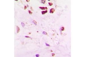 Immunohistochemical analysis of SENP5 staining in human lung cancer formalin fixed paraffin embedded tissue section. (SENP5 antibody  (C-Term))