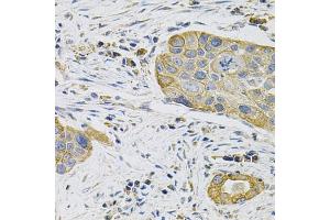 Immunohistochemistry of paraffin-embedded human lung cancer using KRT20 Antibody (ABIN5970078) at dilution of 1/100 (40x lens). (KRT20 antibody)