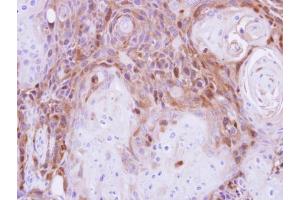 IHC-P Image Peripherin antibody detects PRPH protein at cytosol on Ca922 xenograft by immunohistochemical analysis.