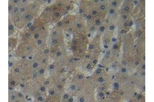 Detection of NNMT in Human Liver cancer Tissue using Polyclonal Antibody to Nicotinamide-N-Methyltransferase (NNMT) (NNMT antibody  (AA 1-258))