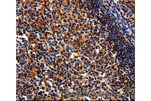Immunohistochemistry of Human liver cancer using BIRC6 Polyclonal Antibody at dilution of 1:50