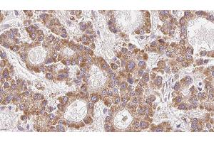 ABIN6279308 at 1/100 staining Human liver cancer tissue by IHC-P. (Claudin 23 antibody  (Internal Region))