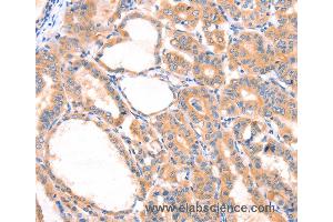 Immunohistochemistry of Human thyroid cancer using PRDX2 Polyclonal Antibody at dilution of 1:80