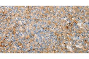 Immunohistochemistry of paraffin-embedded Human liver cancer using IGFBP1 Polyclonal Antibody at dilution of 1:30 (IGFBPI antibody)