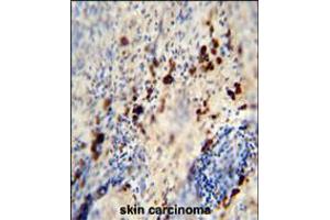 LCE1A antibody immunohistochemistry analysis in formalin fixed and paraffin embedded human skin carcinoma followed by peroxidase conjugation of the secondary antibody and DAB staining.