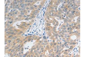 The image on the left is immunohistochemistry of paraffin-embedded Human ovarian cancer tissue using ABIN7192728(TACR2 Antibody) at dilution 1/20, on the right is treated with synthetic peptide.