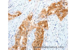 Immunohistochemistry of Human cervical cancer using ANXA8 Polyclonal Antibody at dilution of 1:35 (Annexin VIII antibody)