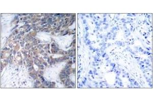Immunohistochemistry analysis of paraffin-embedded human breast carcinoma, using MEK1/2 (Phospho-Ser217) Antibody. (MEK1/2 antibody  (pSer218))