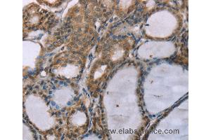 Immunohistochemistry of Human thyroid cancer using ACTN2 Polyclonal Antibody at dilution of 1:30 (ACTN2 antibody)