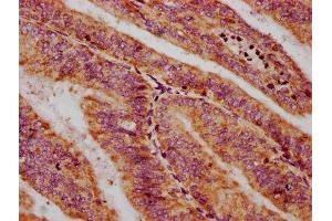 IHC image of ABIN7149635 diluted at 1:400 and staining in paraffin-embedded human endometrial cancer performed on a Leica BondTM system. (CXORF36 antibody  (AA 311-405))