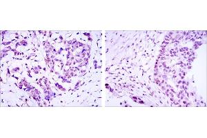 Immunohistochemical analysis of paraffin-embedded breast cancer (left) and ovarian cancer (right) using CRTC3 mouse mAb with DAB staining. (CRTC3 antibody)