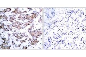 Immunohistochemistry analysis of paraffin-embedded human breast carcinoma, using MEF2A (Phospho-Thr312) Antibody. (MEF2A antibody  (pThr312))