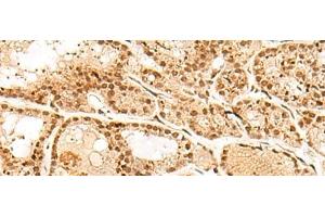 Immunohistochemistry of paraffin-embedded Human thyroid cancer tissue using POLH Polyclonal Antibody at dilution of 1:45(x200) (POLH antibody)