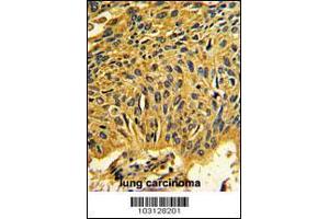 Formalin-fixed and paraffin-embedded human lung carcinoma reacted with CDK2 Antibody , which was peroxidase-conjugated to the secondary antibody, followed by DAB staining. (CDK2 antibody  (C-Term))