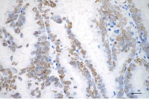 Immunohistochemistry was performed on paraffin-embedded human ovarian carcinoma using checkpoint kinase 2 antibody (ABIN7798039), 1:200). (Recombinant CHEK2 antibody)