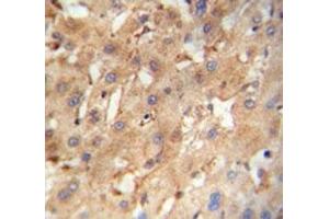 NEU4 antibody immunohistochemistry analysis in formalin fixed and paraffin embedded human hepatocarcinoma. (Sialidase 4 antibody  (AA 423-452))