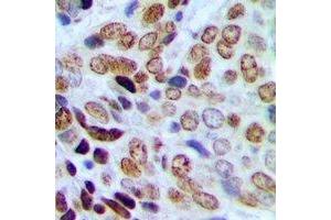 Immunohistochemical analysis of HP1 gamma (pS93) staining in human prostate cancer formalin fixed paraffin embedded tissue section. (CBX3 antibody  (pSer93))