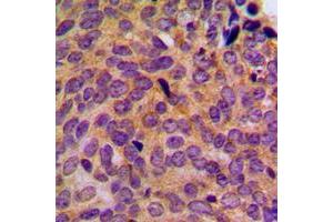 Immunohistochemical analysis of Cytokeratin 5 staining in human breast cancer formalin fixed paraffin embedded tissue section. (Cytokeratin 5 antibody  (C-Term))
