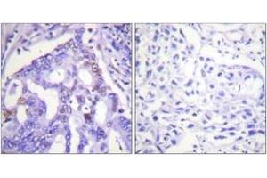 Immunohistochemistry analysis of paraffin-embedded human lung carcinoma tissue, using PIAS4 Antibody. (PIAS4 antibody  (AA 451-500))