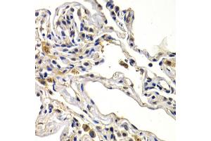 Immunohistochemistry of paraffin-embedded human lung cancer using WNT3A antibody (ABIN6292349) at dilution of 1:200 (40x lens). (WNT3A antibody)