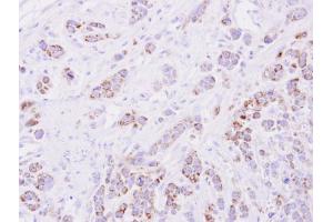 IHC-P Image Immunohistochemical analysis of paraffin-embedded MDA-MB-468 xenograft, using 15-PGDH, antibody at 1:500 dilution. (HPGD antibody  (C-Term))